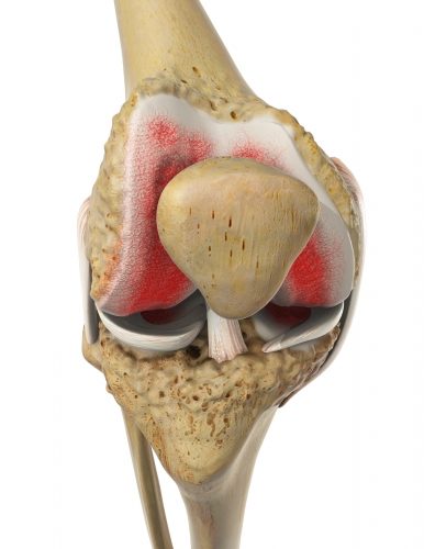 Kniegelenk mit Gonarthrose: Verschleißt die Knorpelschicht, reiben die Knochenflächen im Kniegelenk aufeinander und es entstehen Schmerzen. © Viewmedica Gonarthrose