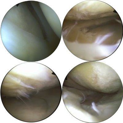 Die Bilder zeigen arthroskopische Aufnahmen des Gelenkknorpels im Kniegelenk. Oben links: Der Knorpel ist gesund und weist eine glatte Oberfläche auf. Dieser Knorpel ist elastisch und widerstandsfähig. Unten links: Dieser Knorpel ist bereits aufgeraut und faserig. Der Wassergehalt ist gesunken. Daher ist er nicht mehr so elastisch (Arthrose Grad 1). Oben rechts: Der Knorpel ist bereits rissig. Das Bindegewebe ist nicht nur oberflächlich zerstört, sondern bis tief in das Knorpelgewebe hinein (Arthrose Grad 3). Unten rechts: Die Knorpelschicht ist bereits ganz abgetragen. Der darunterliegende Knochen ist sichtbar. Man spricht hier von einer Knochenglatze (Arthrose Grad 4). © Gelenk-Klinik.de Arthroskopische Aufnahmen des Gelenkknorpels: unterschiedliche Stadien der Arthrose