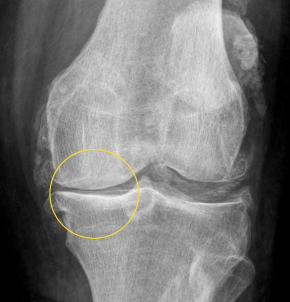 Röntgenbild: sichtbar verschmälerter Gelenkspalt bei Kniearthrose