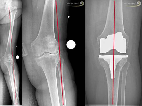 Knieprothese bei Valgusgonarthrose
