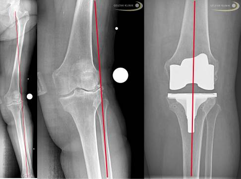 Слева: Вальгусная деформация ноги (осевая деформация с выступающей голенью). Красная линия отображает осевую нагрузку. По середине: увеличенный разрез и заметный вальгусный гонартроз  (артроз внешней камеры колена). Справа: рентгеновское изображение после операции по тотальному эндопротезированию и выравниванию оси нижней конечности. Смещение оси ног необходимо исправлять так как патология может повлиять на лодыжку, бедро и позвоночник.© Gelenk-Klinik 
