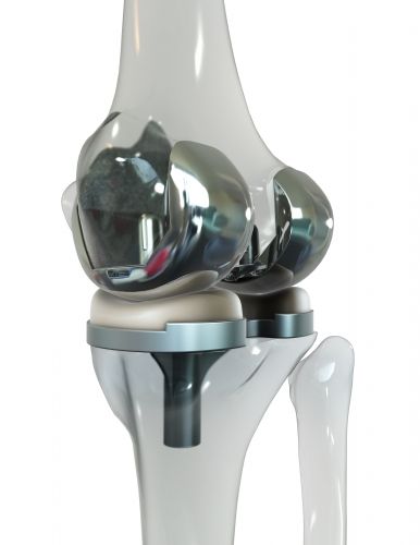 Knieendoprothese von schräg hinten © Viewmedica 