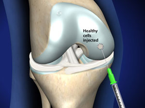 Knorpelschaden Im Knie Und Knorpeltransplantation Gelenk Klinik De