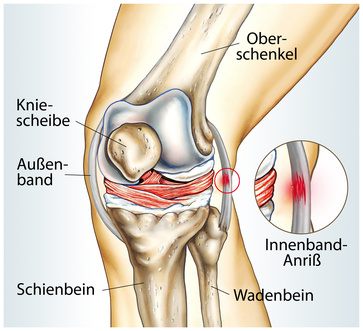 Knieschmerz Innen Am Kniegelenk Medialer Knieschmerz Gelenk Klinik De