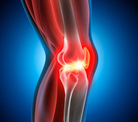 schmerzendes Kniegelenk aufgrund von Osteochondrosis dissecans
