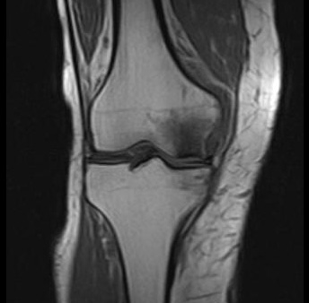 МРТ при некрозе костей колена. Нормальная ширина суставной щели, суставный хрящ ещё не поврежден. Отчетливое изображение некроза внутреннего мыщелка бедренной кости. © Prof. Dr. med. Sven Ostermeier