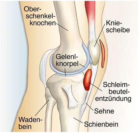 Im Kniegelenk gibt es mehrere Schleimbeutel, die sich schmerzhaft entzünden können