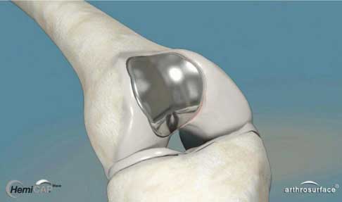 femoropatelarna artroza koljena)