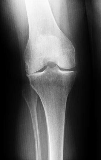 laterale (äußere) Kniearthrose
