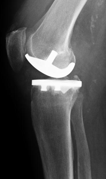 unikondyläre Teilprothese im Kniegelenk