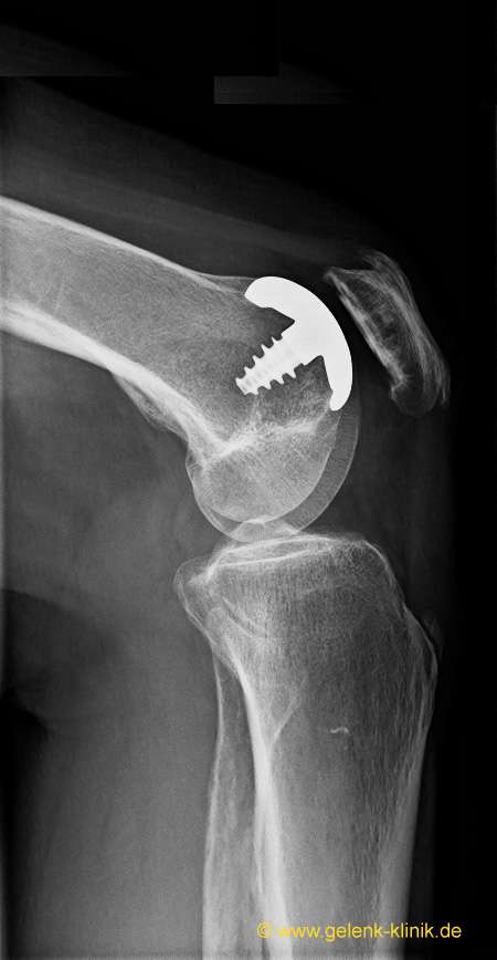 Wenn die retropatellare Arthrose beide Gelenkflächen – Patella und Oberschenkel – betrifft, kommt eine retropatellare Prothese mit patellaseitiger PET-Gleitschicht zum Einsatz. Dieses Röntgenbild zeigt nur die Metallkomponente. Der Kunststoff wird im Röntgen nicht dargestellt. © Prof. Dr. med. Ostermeier