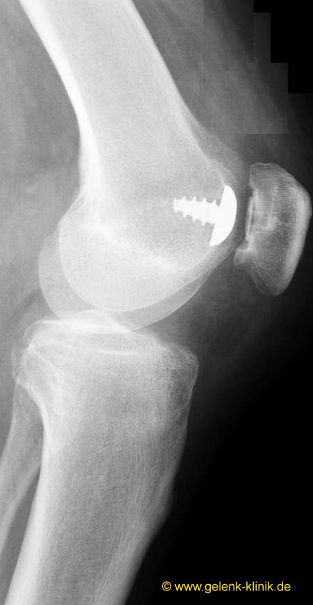 Eine isolierte Arthrose hinter der Kniescheibe kann durch ein speziell angepasstes Implantat behandelt werden. Das Hemicap-Implantat formt die retropatellare Gleitrinne nach. © Prof. Dr. med. Ostermeier