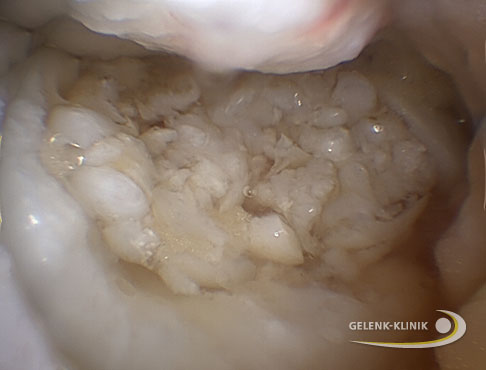 fertige Knorpeltransplantat ist nun stabil