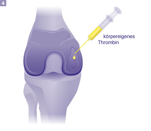 Fixieren des Knorpelimplantats mit Thrombin