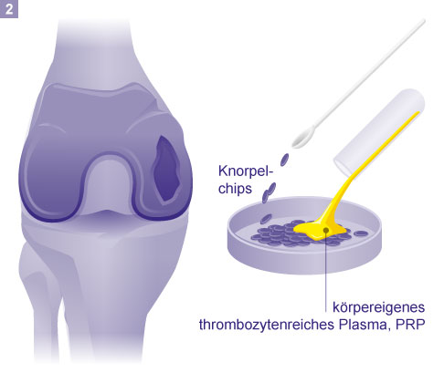 Vermischen der Knorpelchips mit körpereigenem PRP