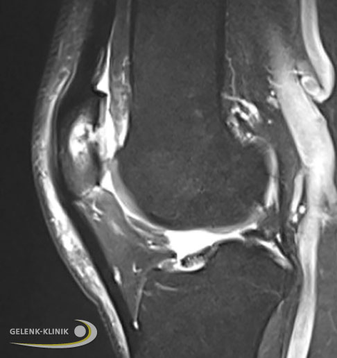 Knorpelschaden im Kniegelenk, seitlich