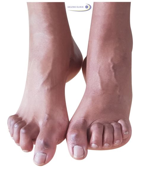 Bei Krallenzehen handelt es sich um ein kosmetisches Problem. Die Zehenfehlstellung ist meist schmerzfrei. © Gelenk-Klinik Typisches Aussehen der Krallenzehen