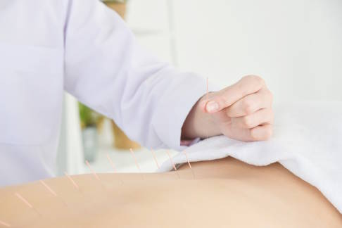 Akupunktur des Rückens