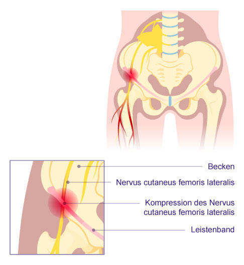 Anatomische Darstellung des Beckens mit Verlauf des Nervus cutaneus femoris lateralis unter dem Leistenband; die Kompressionsstelle bei Meralgia paraesthetica ist im Bereich des Leistenbandes markiert.