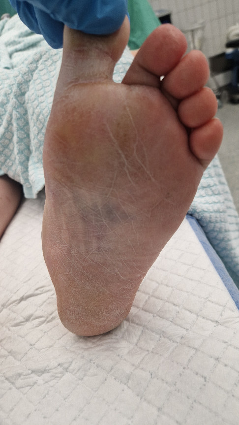 Fußsohlenhämatom bei Lisfranc-Verletzung