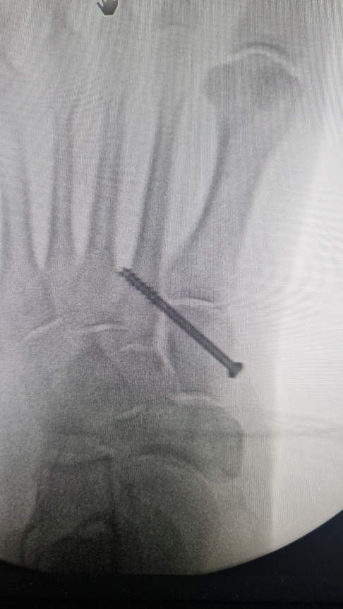 Mit Stellschraube versorgte Lisfranc-Verletzung