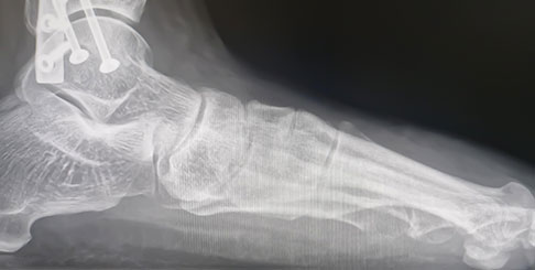 Vertikale Instabilität bei Lisfranc-Verletzung