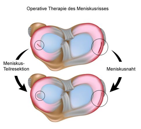 Ein Meniskusriss kann auf zweierlei Arten operiert werden. Bei der Meniskusresektion wird ein Teil des beschädigten Meniskus entfernt, um die Oberfläche zu glätten. Bei der Meniskusnaht wird der beschädigte Anteil des Meniskus wieder angenäht, um ein Zusammenheilen der Fragmente zu erreichen. Die Naht des Meniskus ist nur dann möglich, wenn der Meniskusriss in der Nähe der gut durchbluteten Basis des Meniskus liegt. © Alila Medical Media @ Fotolia Ein Meniskusriss kann auf zweierlei Arten operiert werden. Bei der Meniskusresektion wird ein Teil des beschädigten Meniskus entfernt, um die Oberfläche zu glätten. Bei der Meniskusnaht wird der beschädigte Anteil des Meniskus wieder angenäht, um ein Zusammenheilen der Fragmente zu erreichen. © istockphoto