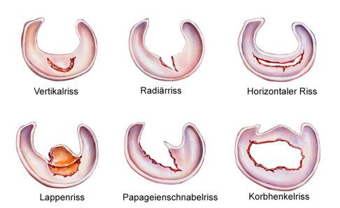 Arten des Meniskusrisses