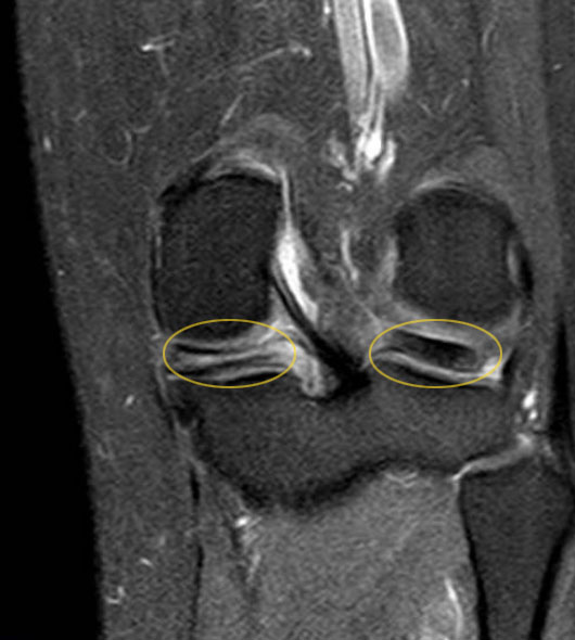 Die Knieverletzung zeigt einen deutlichen horizontalen Meniskusriss entlang der Längsachse (gelbe Markierung links). Der andere Meniskus im Kniegelenk (Markierung rechts) ist noch intakt, deutlich erkennbar an der größeren dunklen Fläche. © gelenk-klinik.de