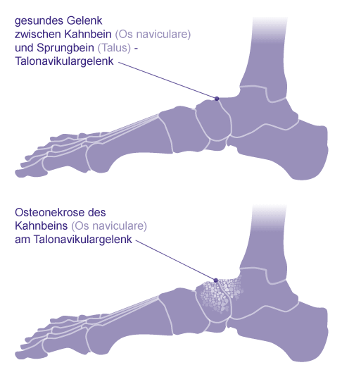 Osteonekrose am Kahnbein