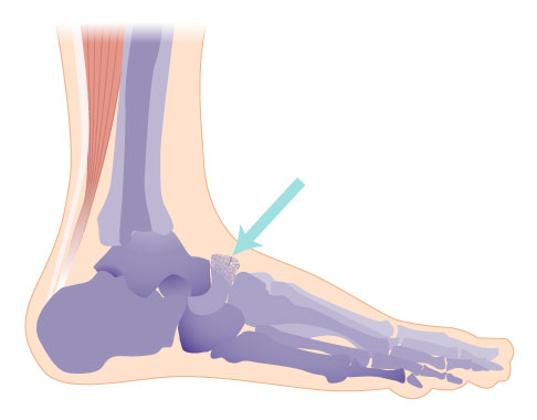 Schematische darstellung des Müller-Weiß-Syndrom