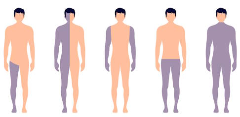 Lähmungsarten: 1. Monoplegie, 2. Hemiplegie, 3. Diplegie, 4. Paraplegie, 5. Quadriplegie/Tetraplegie. © Orapun, Adobe Grafik: Lähmungsarten