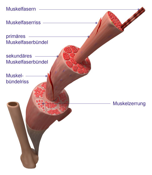 Muskelverletzungen im Vergleich