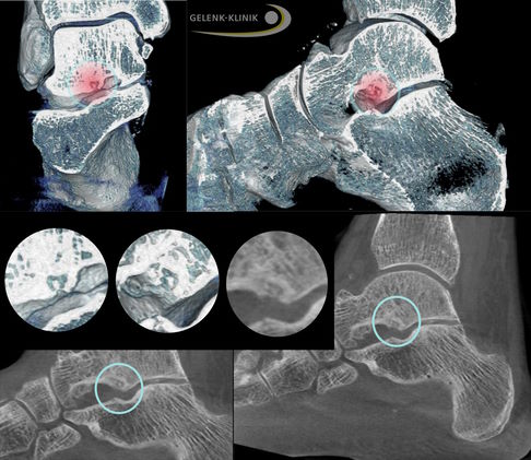 Osteoidosteoms am Sprungbeinhals (Talushals)