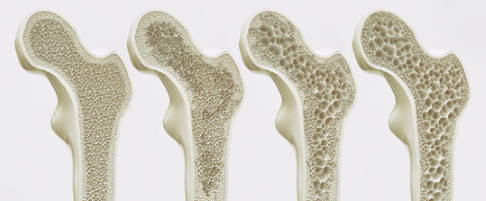 Vier Stadien der Osteoporose