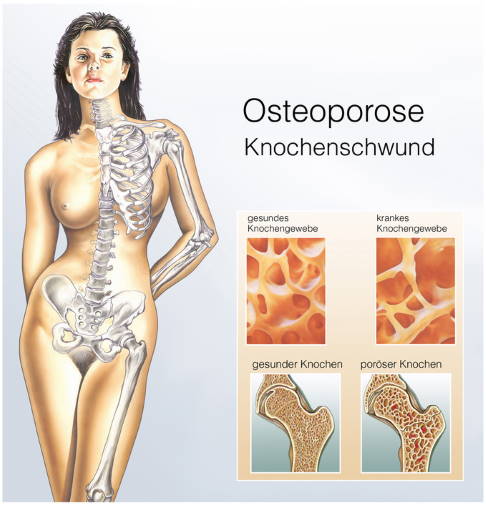 Bei einer Osteoporose verringert sich die Knochendichte.