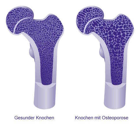 Vergleich gesunder Knochen und Knochen mit Osteoporose