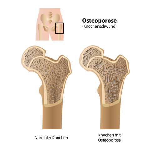 Чаще всего остеопороз появляется на шейке бедра. Отторжение костных структур является особенно сложной задачей для эндопротезирования. © bilderzwerg, Fotolia