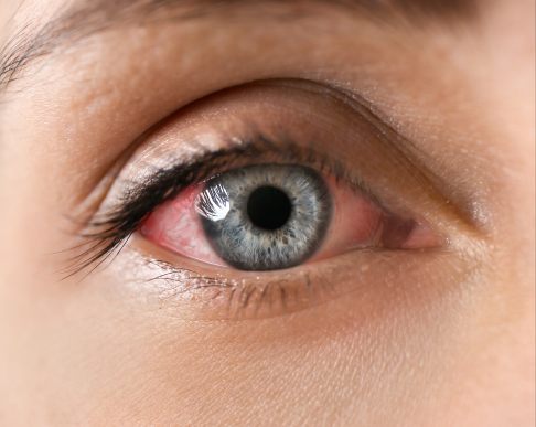 Rheumasymptome an den Augen