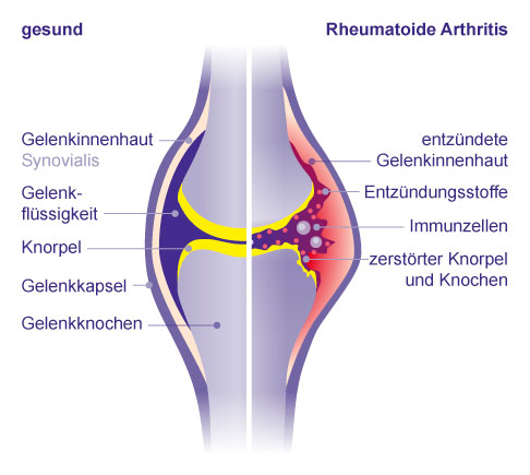  Vergleich gesundes Gelenk mit rheumatoider Arthritis