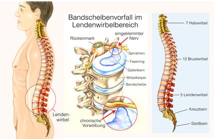 Grafik: Bandscheibenvorfall im unteren Rücken