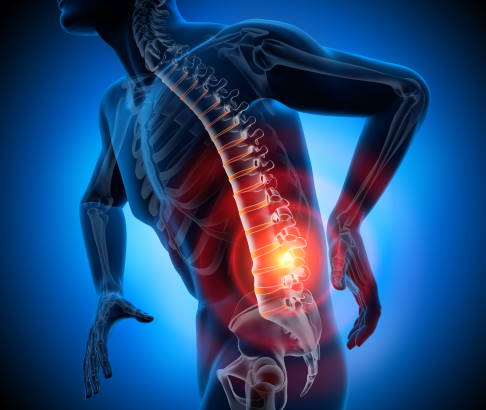 Grafik: Mann mit Schmerzen im unteren Rücken bei Failed-Back-Surgery-Syndrom