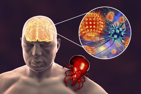 Meningitis durch Zeckenbiss