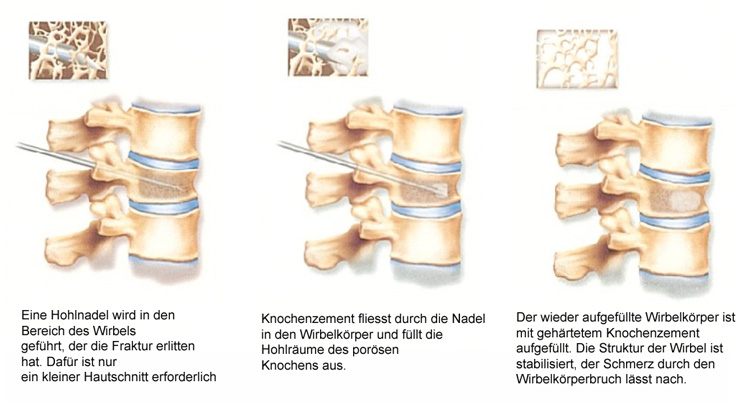 Vertebroplastie mit Knochenzement