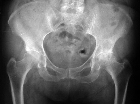 Röntgenbild einer Hüftgelenksarthrose