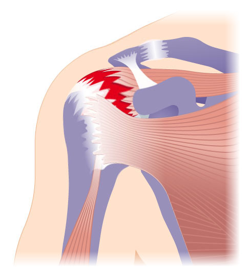 Darstellung einer Cuff-Arthropathie