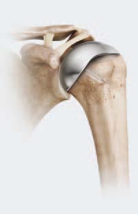 Hemiprothese oder Teilprothese als Schulterprothese