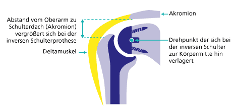  Die Inverse Schulterprothese vertauscht PFanne und Kugel. Es kommt zu einer Verschiebung des Drehzentrums des Gelenkes zur Körpermitte und nach unten, wodurch der Deltamuskel eine Vorspannung erfährt und nun in der Lage ist den Arm anzuheben.