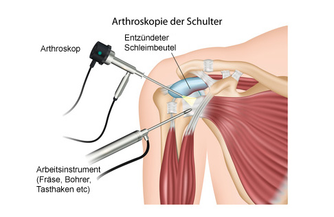 Schulterarthroskopie: Entfernung des entzündeten Schleimbeutels.