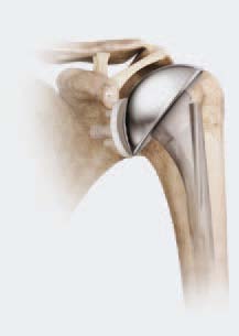 Totalendoprothese als schulterprothese